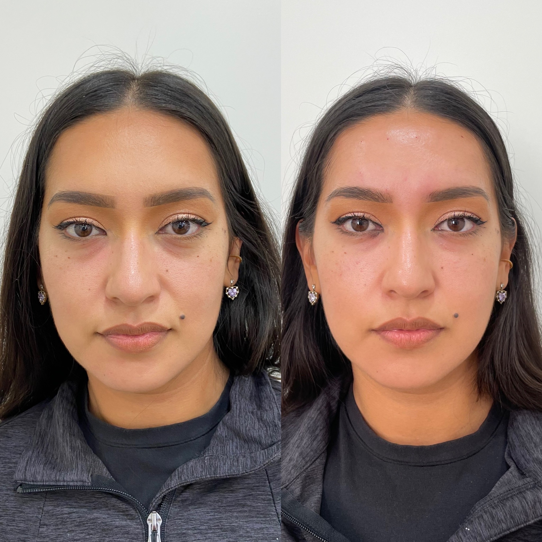 Before and After Fillers Treatment | Beauty Boost Med Spa in Newport Beach, CA