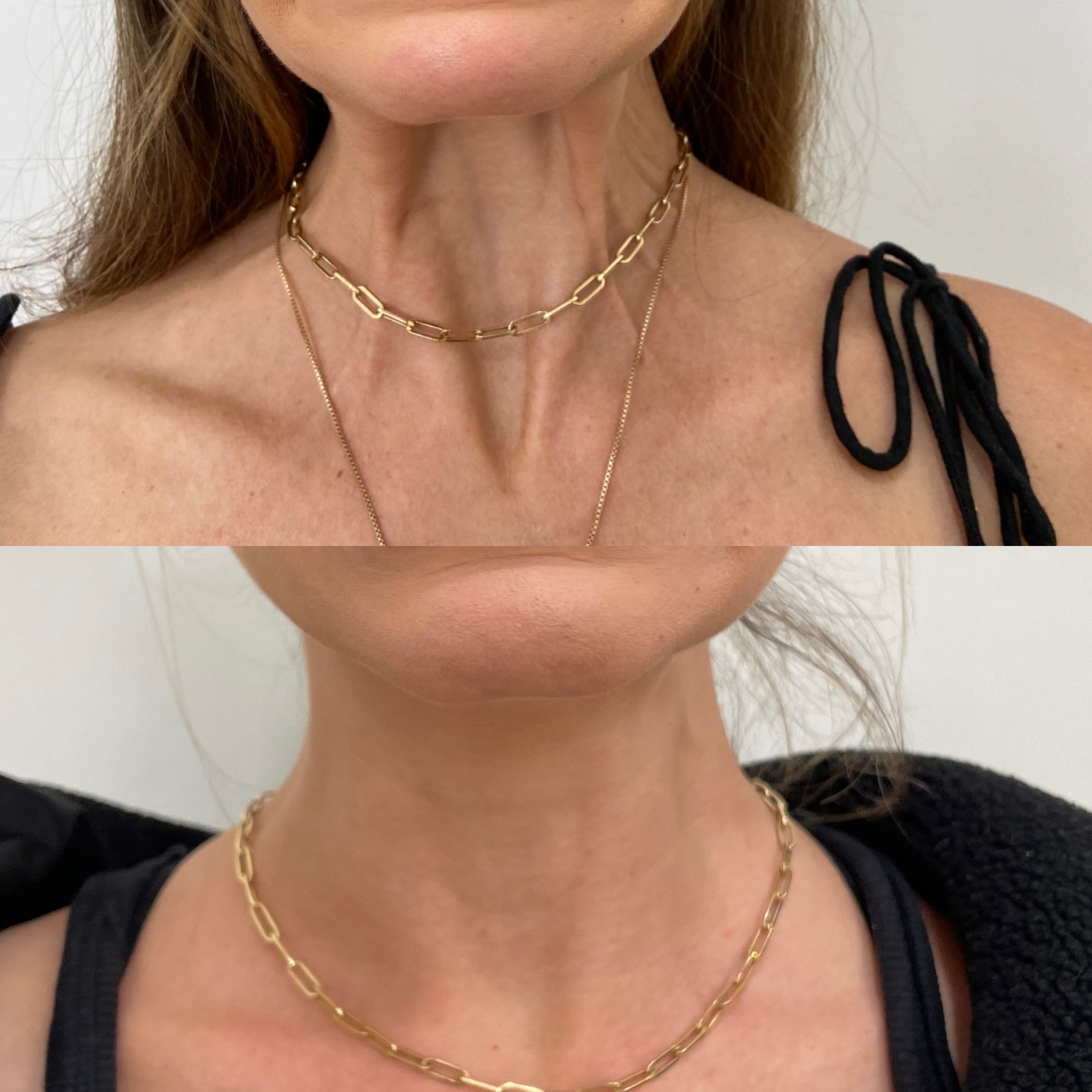 Before and After Botox Treatment on Neck | Beauty Boost Med Spa in Newport Beach, CA