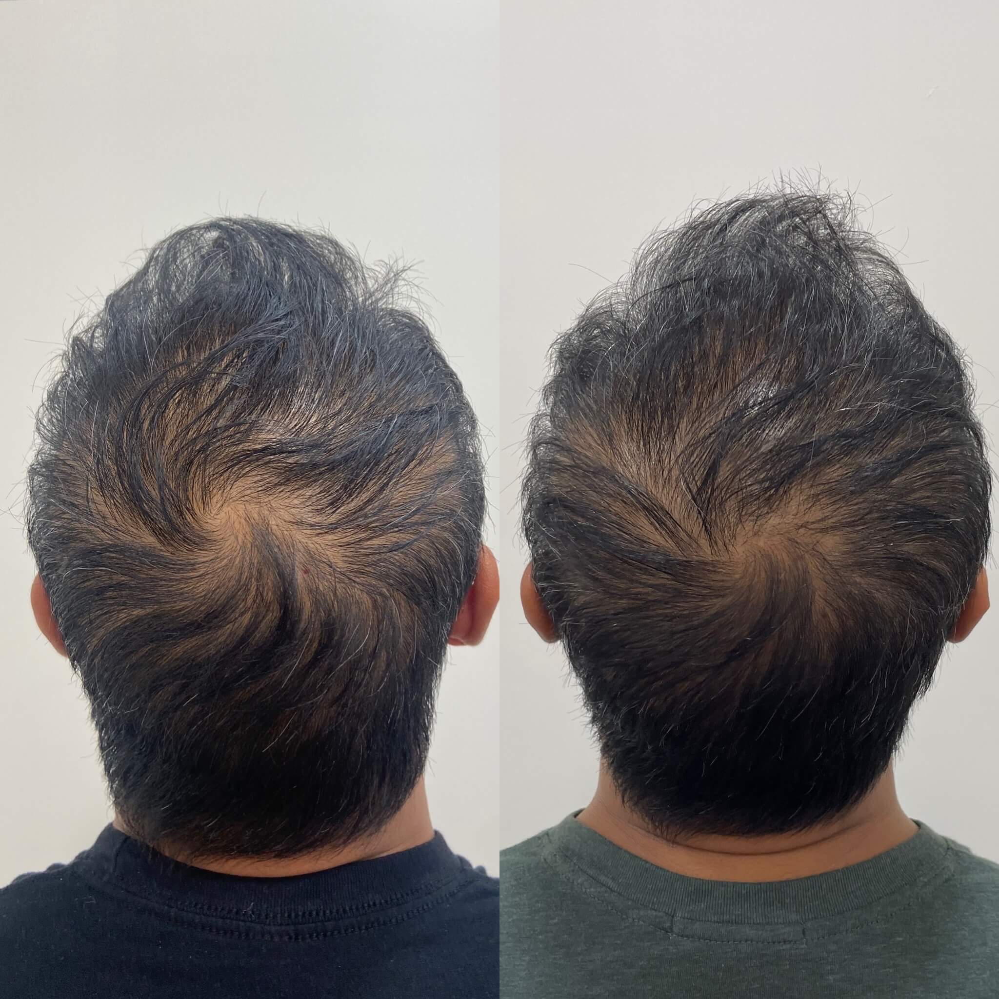 Collagen Stimulators 32 Before and After PRP Hair Restoration Treatment | Beauty Boost Med Spa in Newport Beach, CA