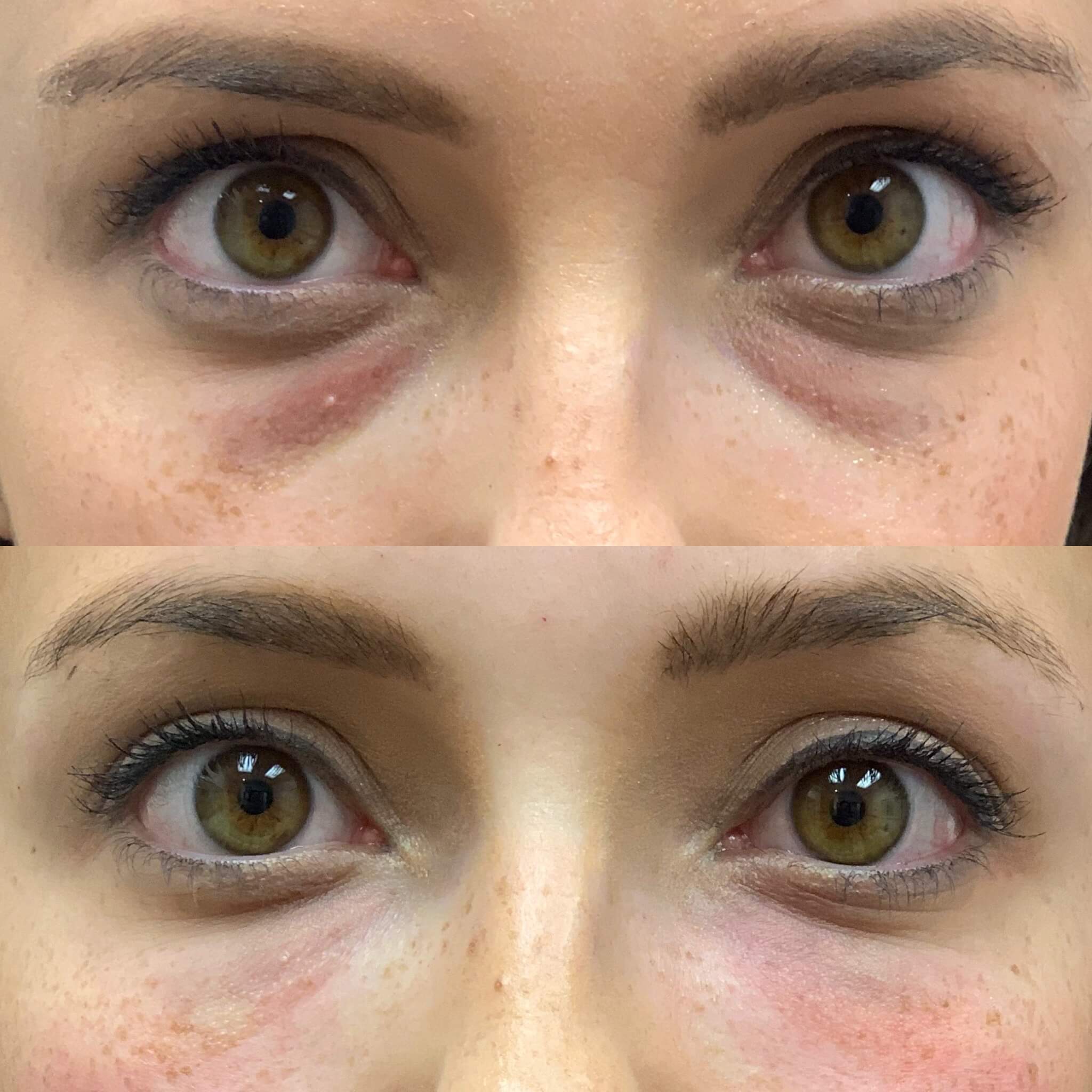 Before and After Collagen Stimulators Treatment | Beauty Boost Med Spa in Newport Beach, CA