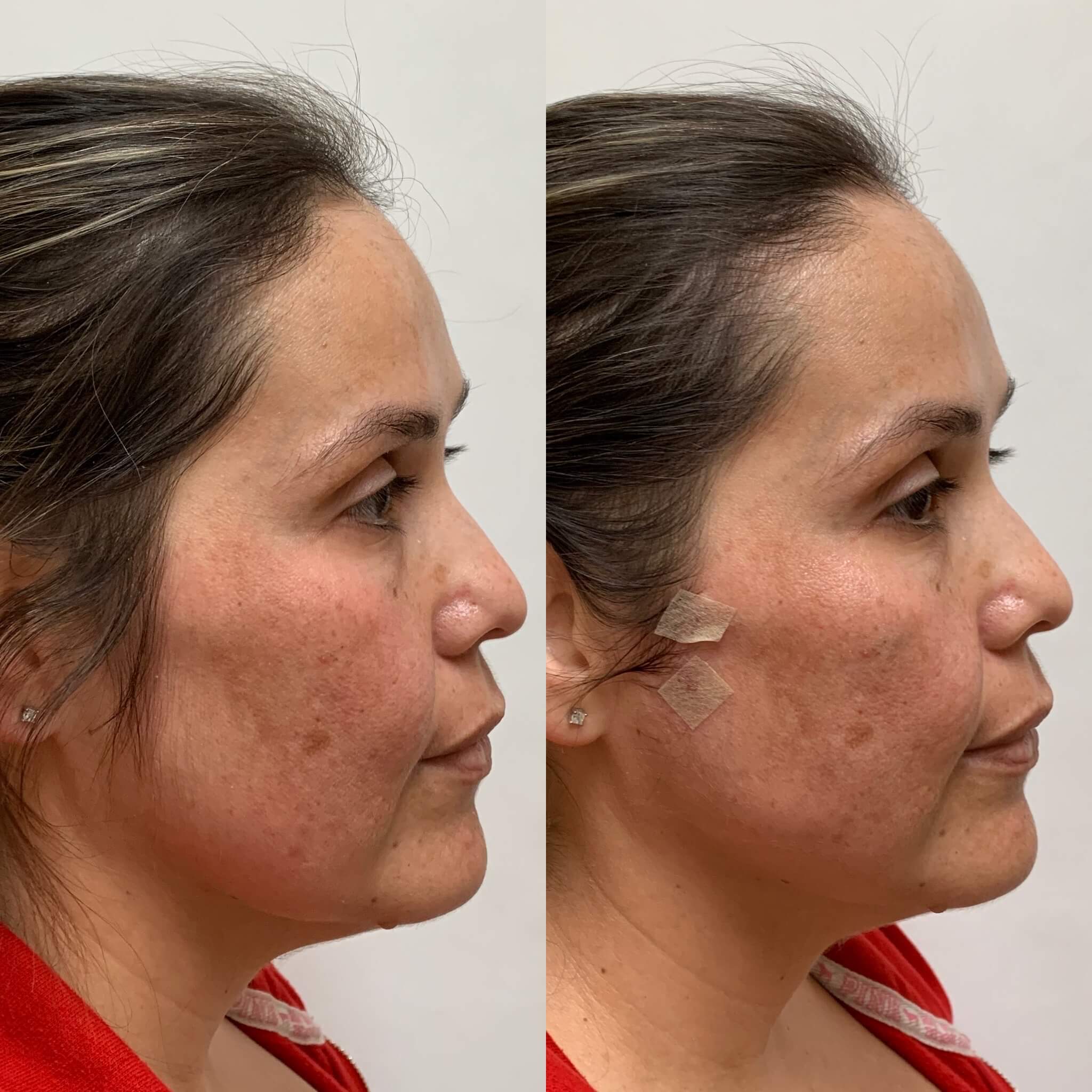 PDO Thread Lift 51 Before and After PDO Thread lift Treatment | Beauty Boost Med Spa in Newport Beach, CA
