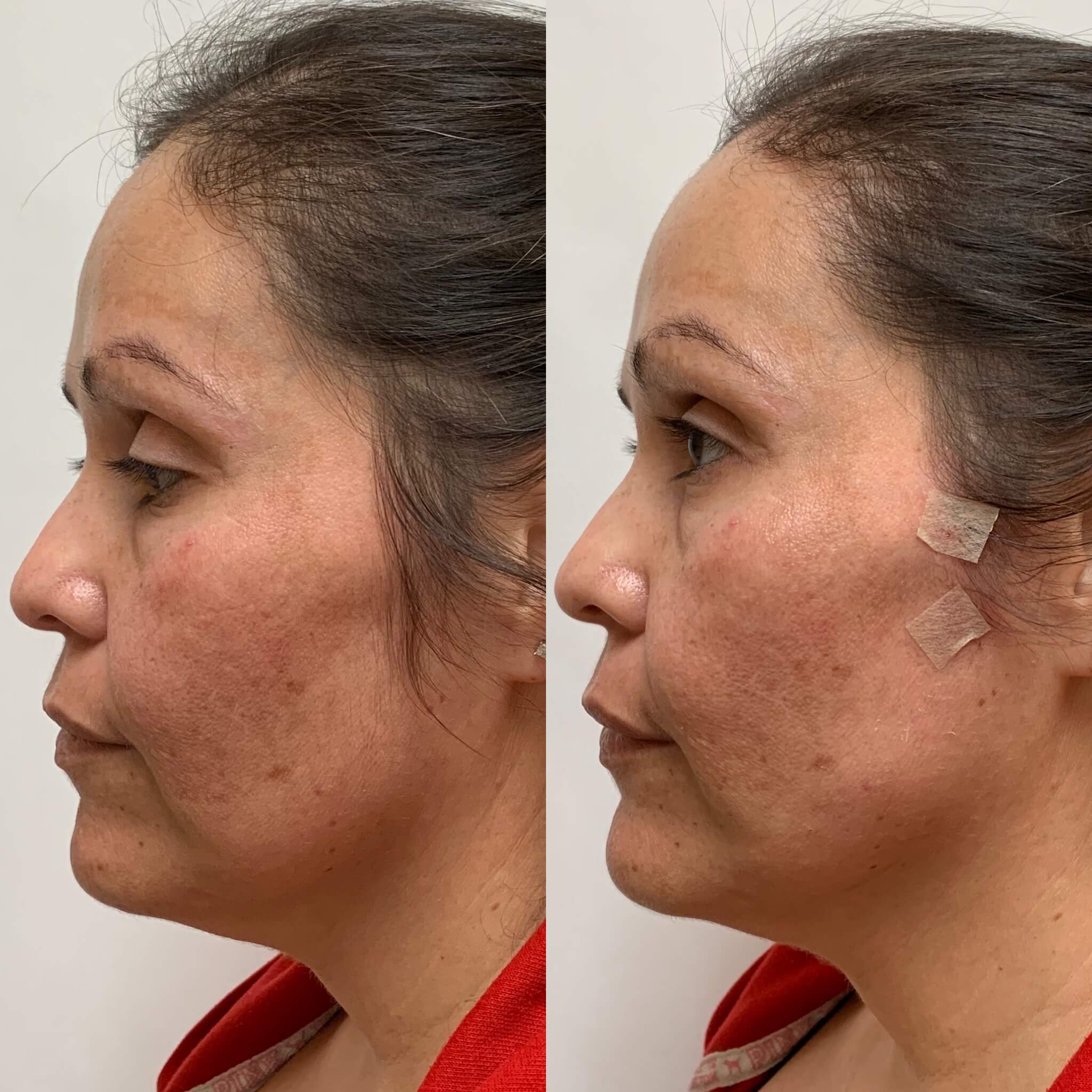 Before and After PDO Thread lift Treatment | Beauty Boost Med Spa in Newport Beach, CA