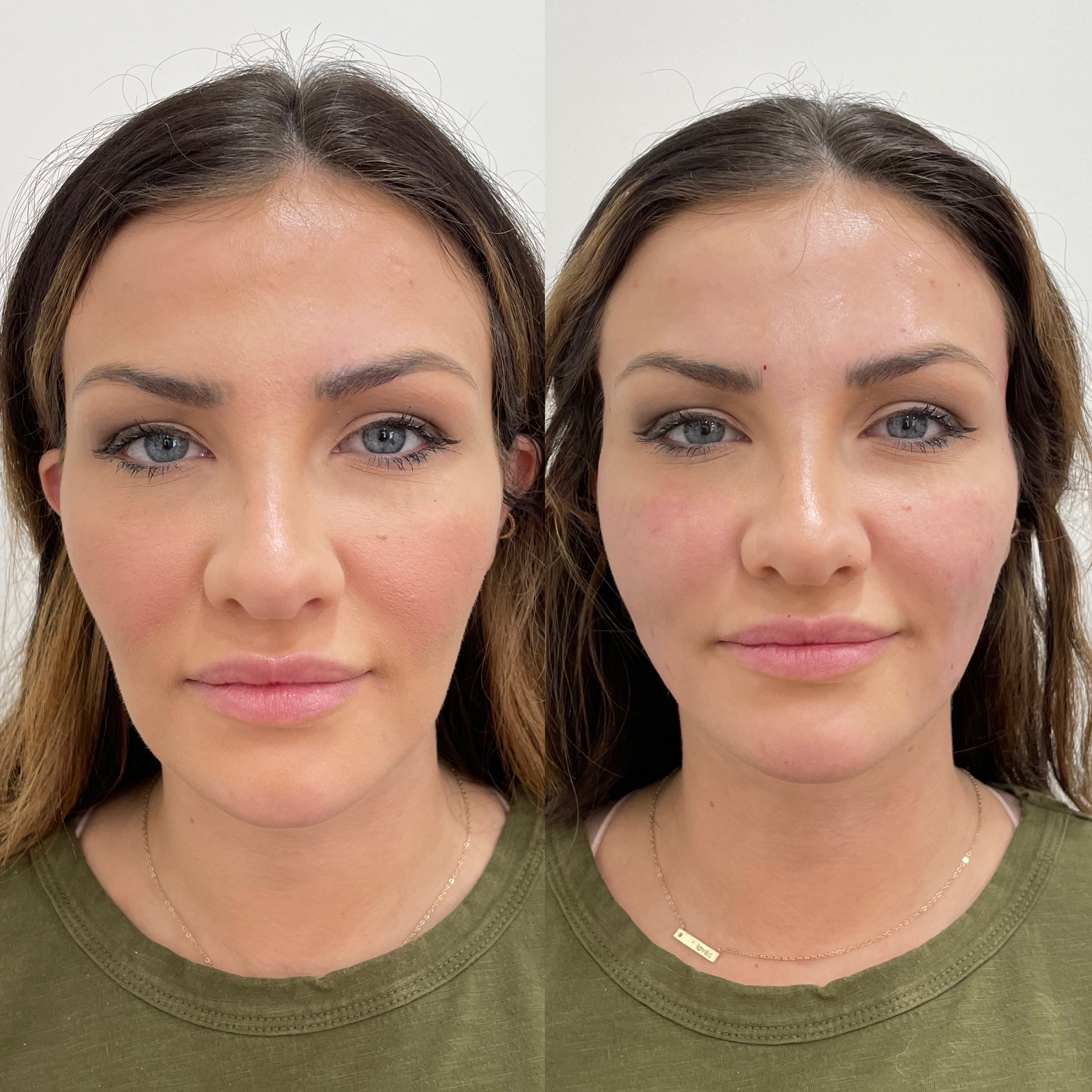 Before and After Thread lift treatment | Beauty Boost Med Spa in Newport Beach, CA