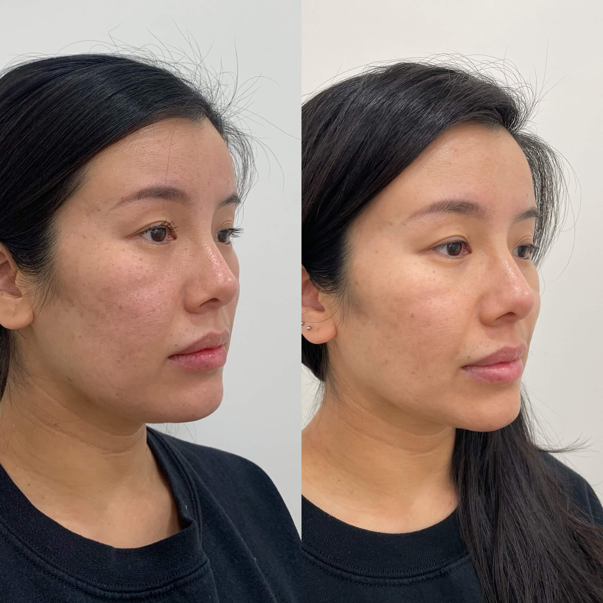 PDO Thread Lift 86 Before and After PDO Thread lift Treatment | Beauty Boost Med Spa in Newport Beach, CA