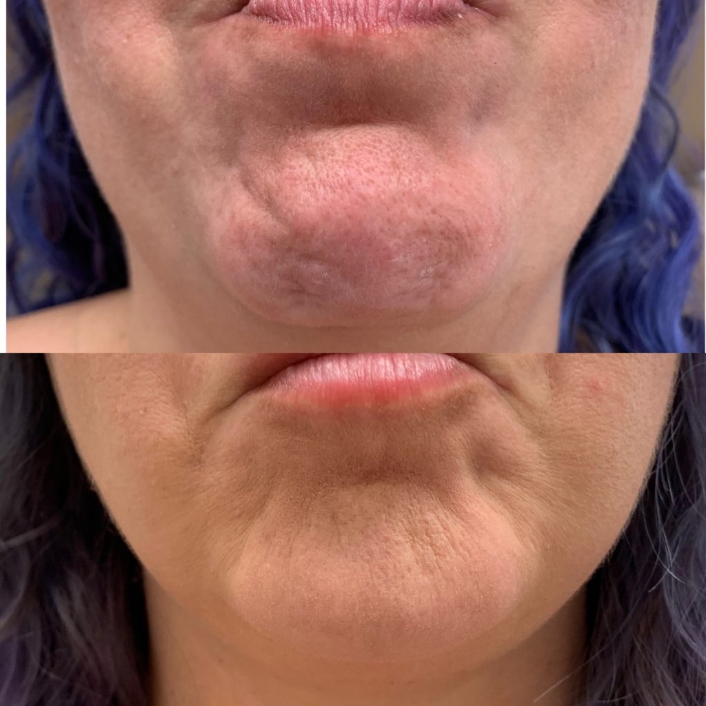 Before and After Botox Dao Chin treatment | Beauty Boost Med Spa in Newport Beach, CA