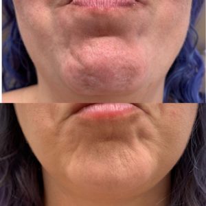 Before and After Botox Beauty Boost in Newport Beach, CA