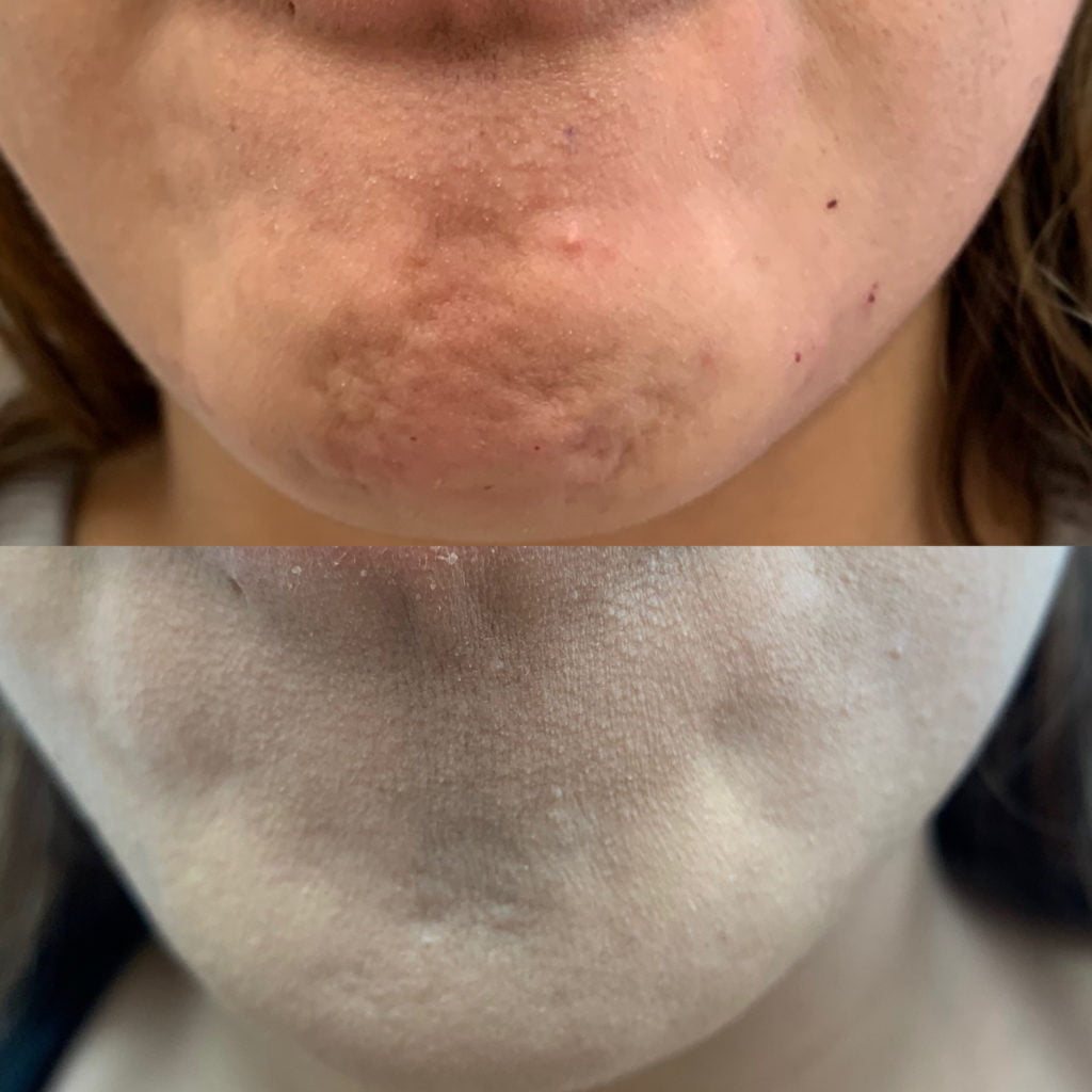 Before and After Botox Dao Chin treatment | Beauty Boost Med Spa in Newport Beach, CA