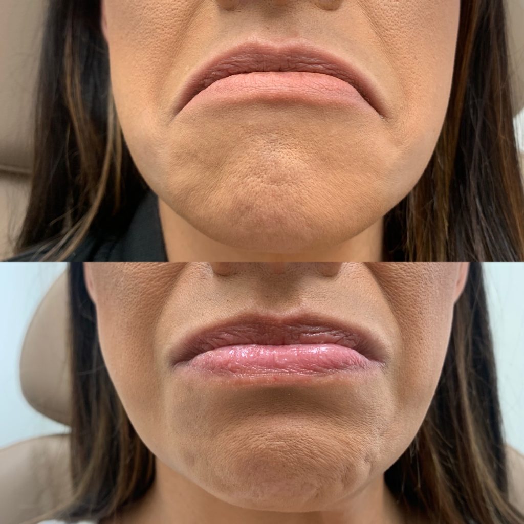 Before and After Botox Dao Chin treatment | Beauty Boost Med Spa in Newport Beach, CA
