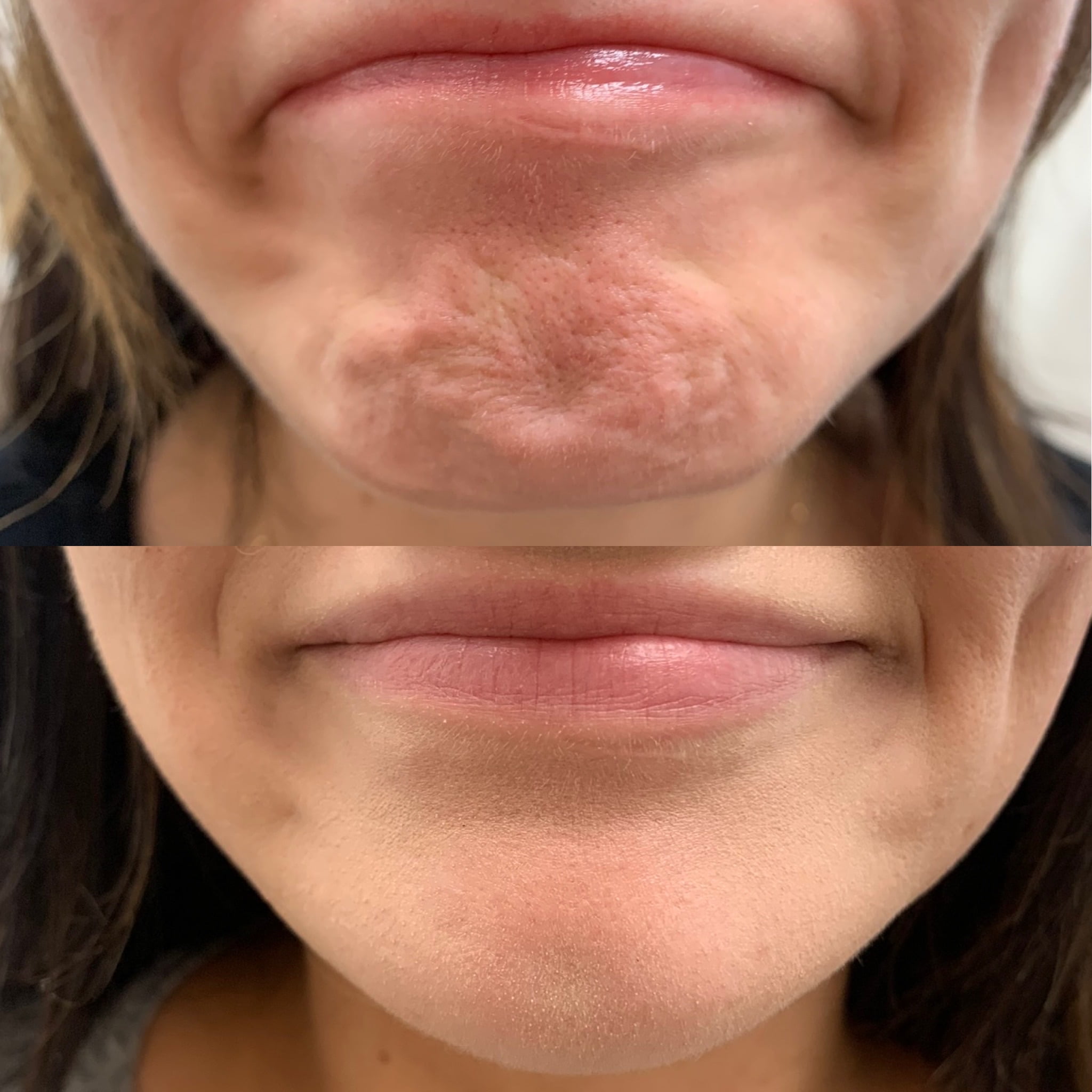 Before and After Botox Dao Chin treatment | Beauty Boost Med Spa in Newport Beach, CA