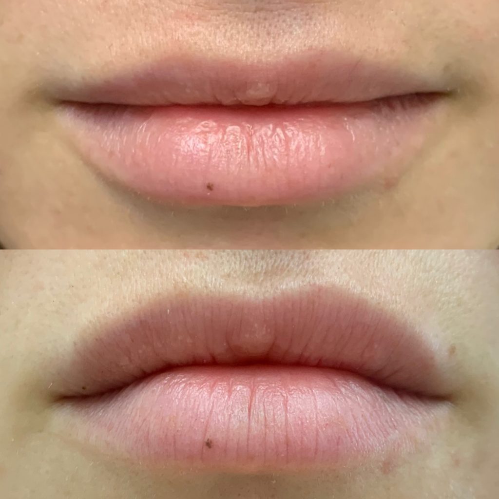Before and After Botox Dao Chin treatment | Beauty Boost Med Spa in Newport Beach, CA