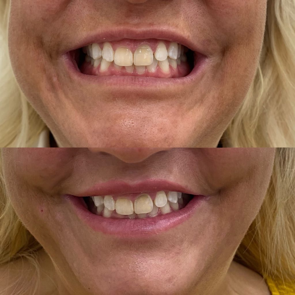 Before and After Botox Dao Chin treatment | Beauty Boost Med Spa in Newport Beach, CA
