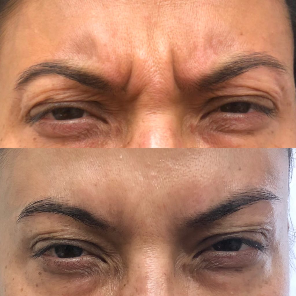 Before and After Botox Frown-fh Treatment | Beauty Boost Med Spa in Newport Beach, CA