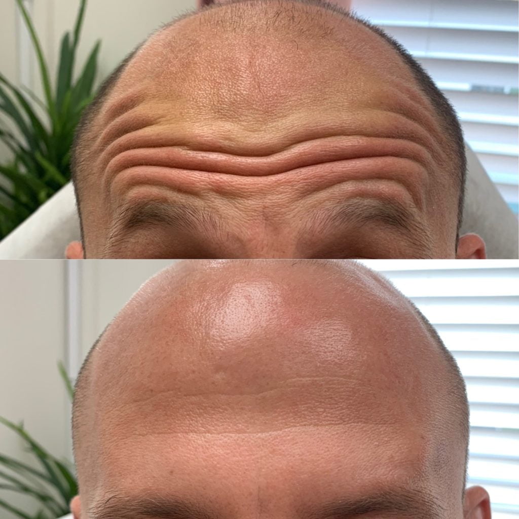 Before and After Botox Frown-fh Treatment | Beauty Boost Med Spa in Newport Beach, CA