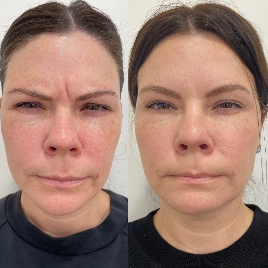 Before and After Botox Frown-fh Treatment | Beauty Boost Med Spa in Newport Beach, CA