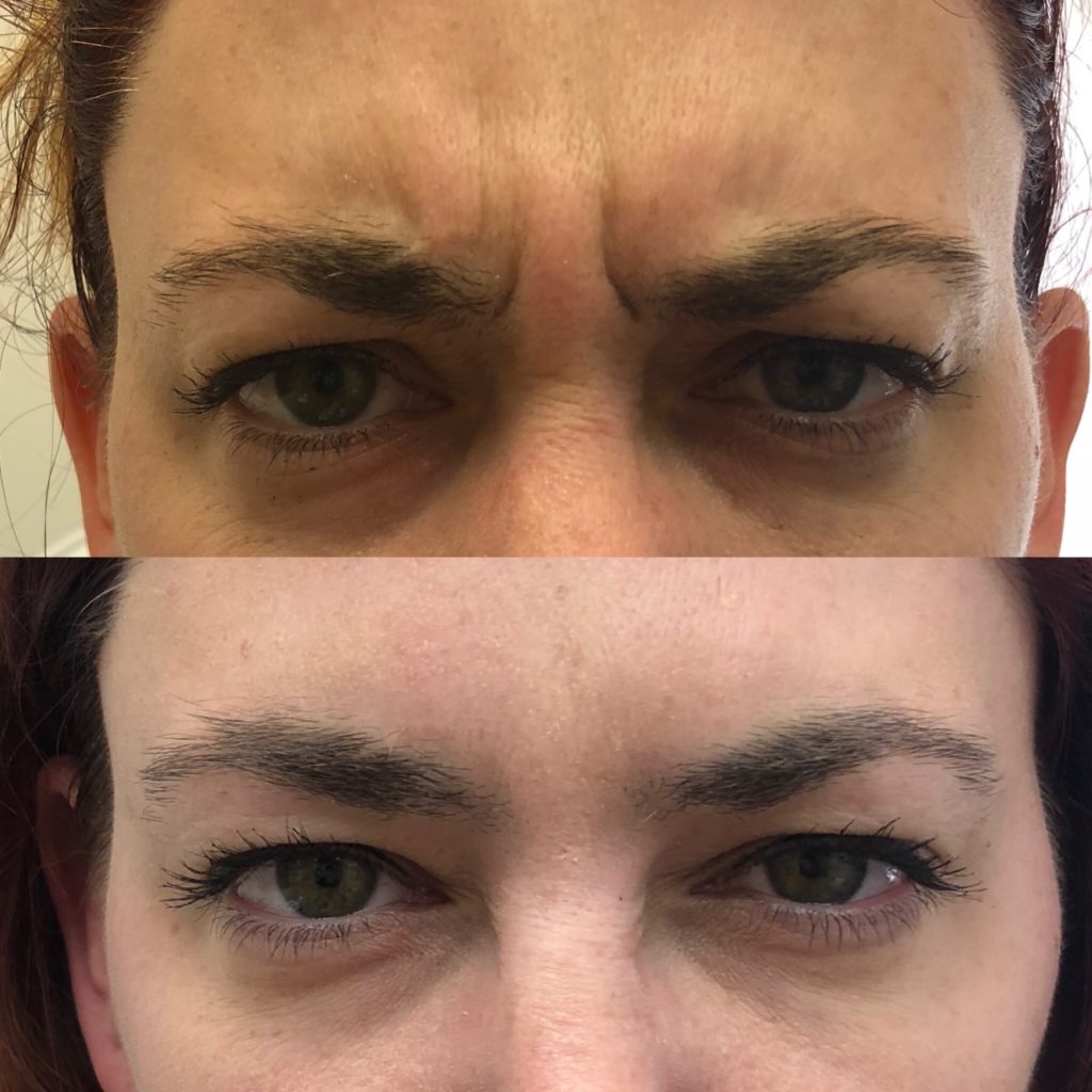 Before and After Botox Frown-fh Treatment | Beauty Boost Med Spa in Newport Beach, CA