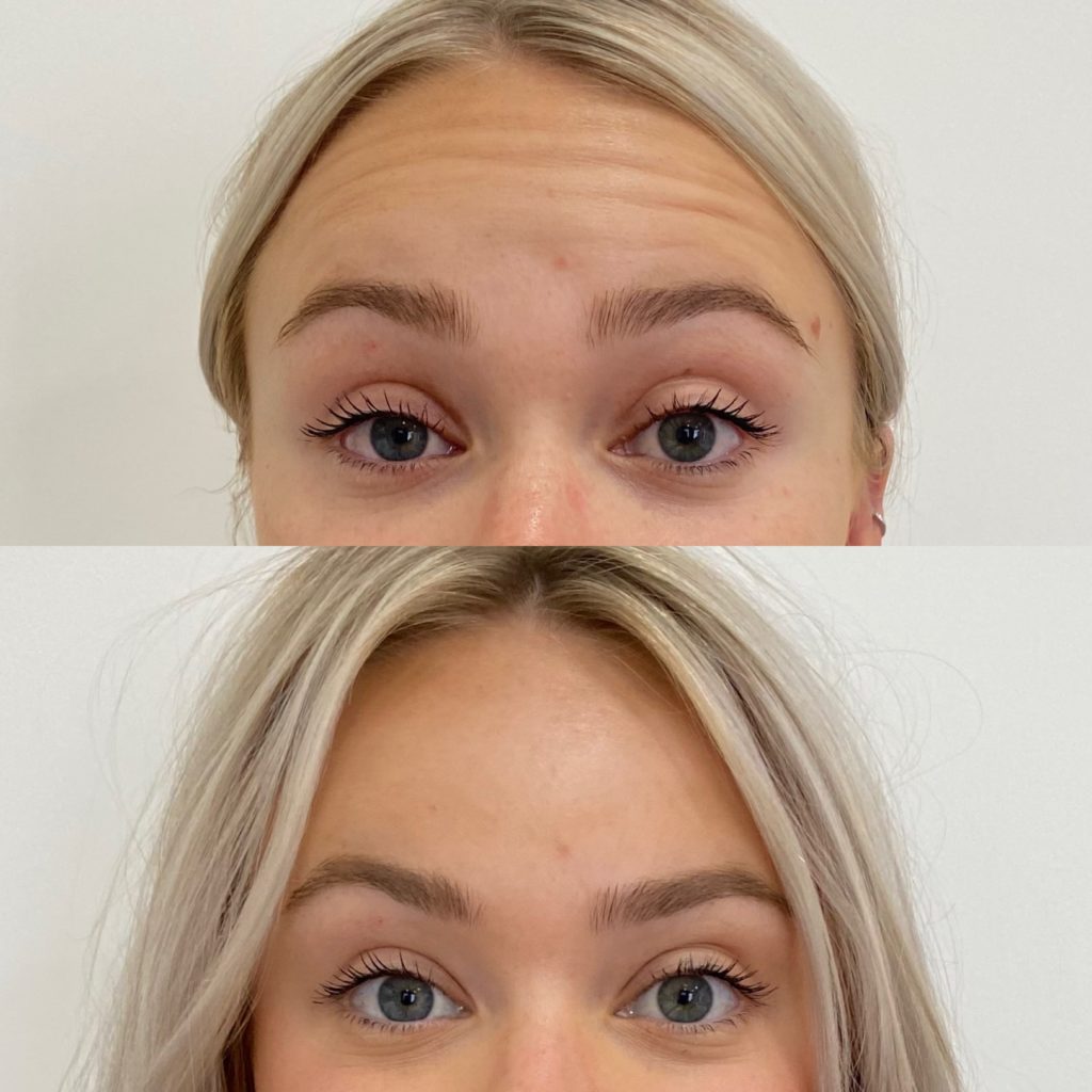 Before and After Botox Frown-fh Treatment | Beauty Boost Med Spa in Newport Beach, CA