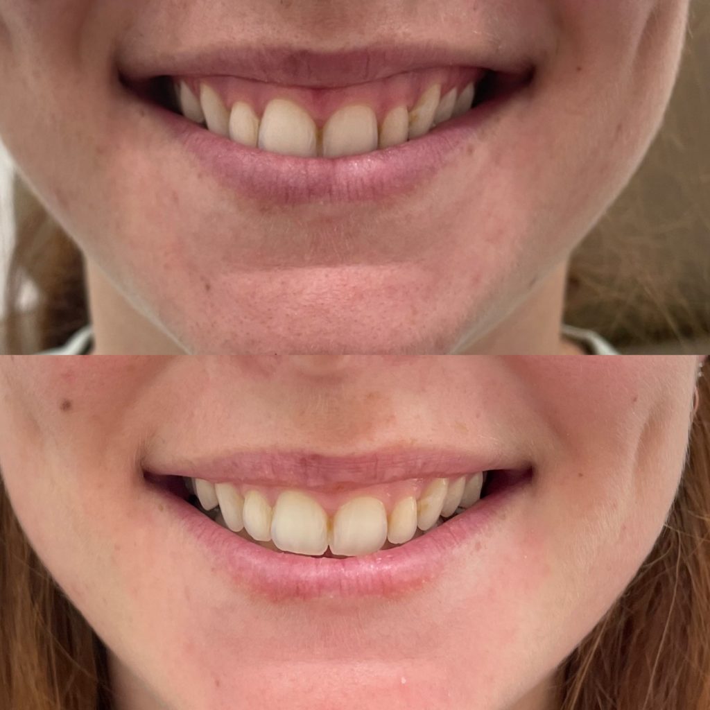 Before and After Botox Gummy Treatment | Beauty Boost Med Spa in Newport Beach, CA