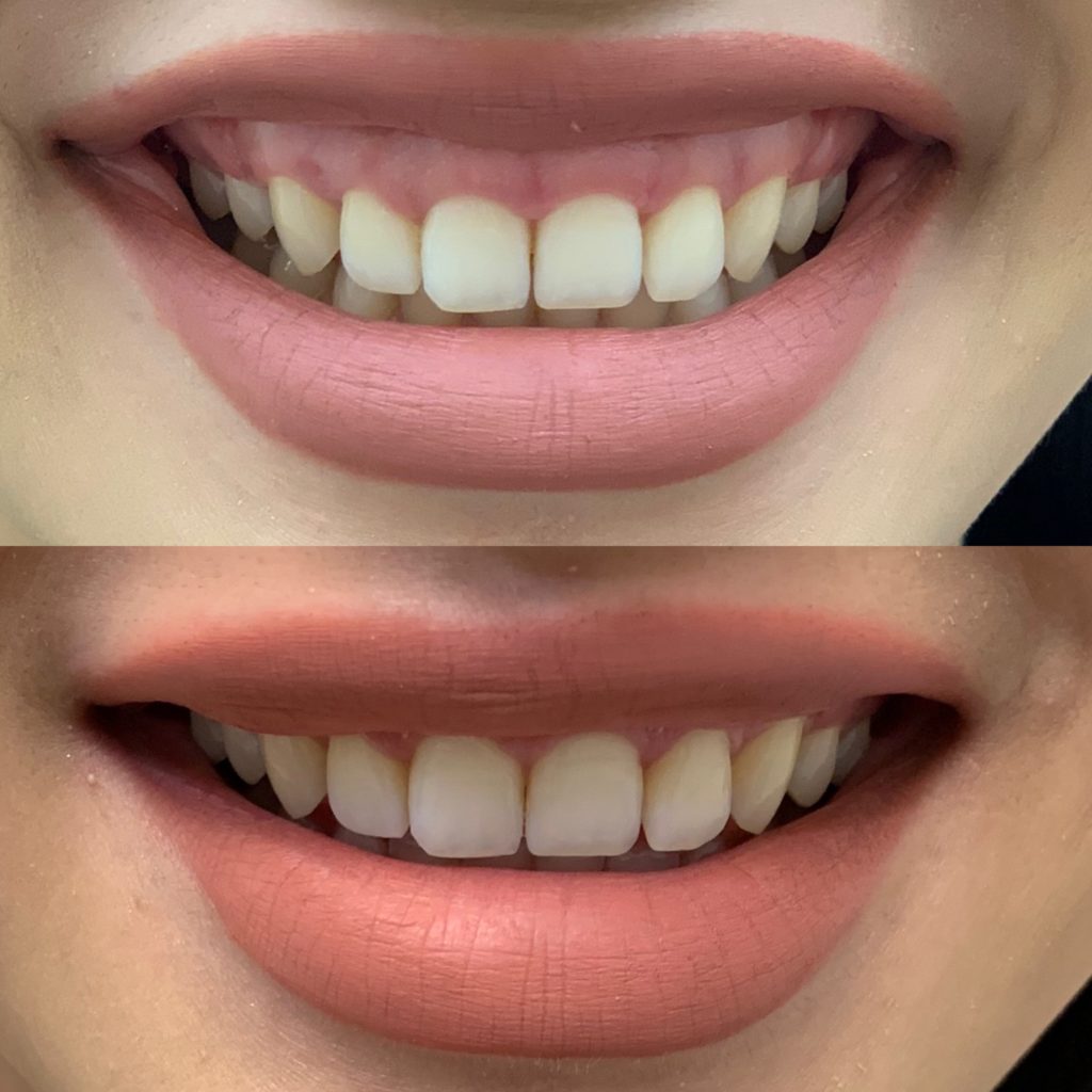 Before and After Botox Gummy Treatment | Beauty Boost Med Spa in Newport Beach, CA