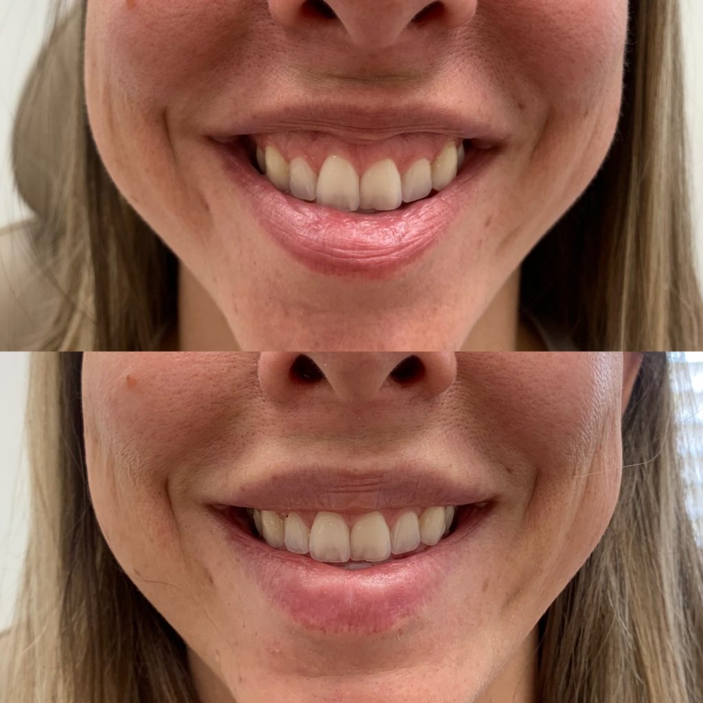 Before and After Botox Gummy Treatment | Beauty Boost Med Spa in Newport Beach, CA