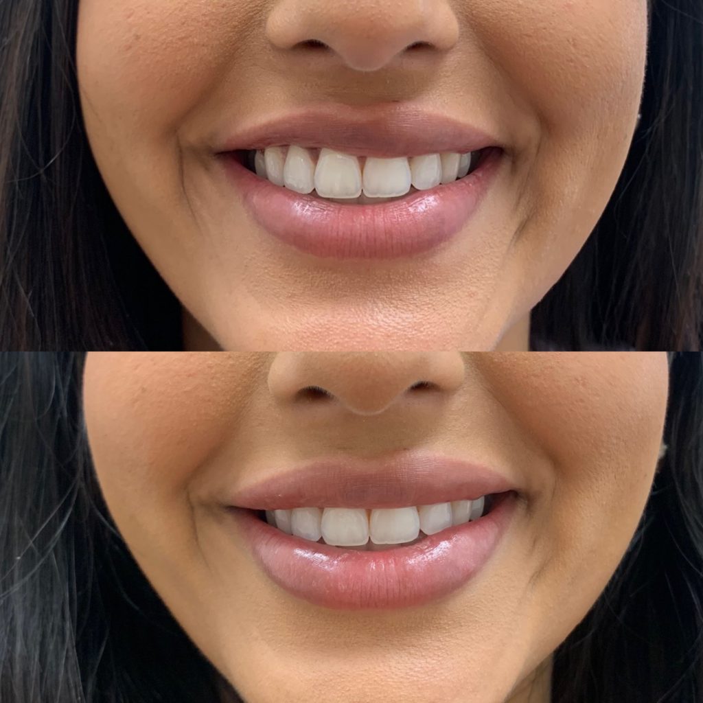 Before and After Botox Gummy Treatment | Beauty Boost Med Spa in Newport Beach, CA