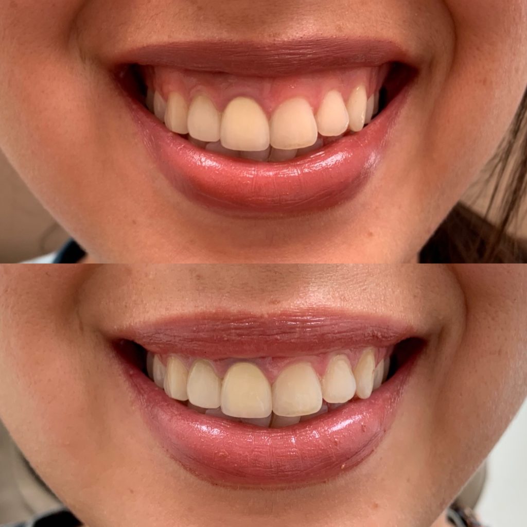 Before and After Botox Gummy Treatment | Beauty Boost Med Spa in Newport Beach, CA