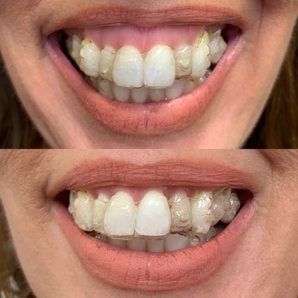 Before and After Botox Gummy Treatment | Beauty Boost Med Spa in Newport Beach, CA