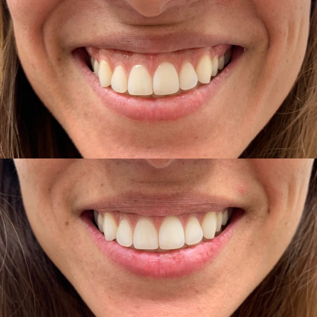 Before and After Botox Gummy Treatment | Beauty Boost Med Spa in Newport Beach, CA