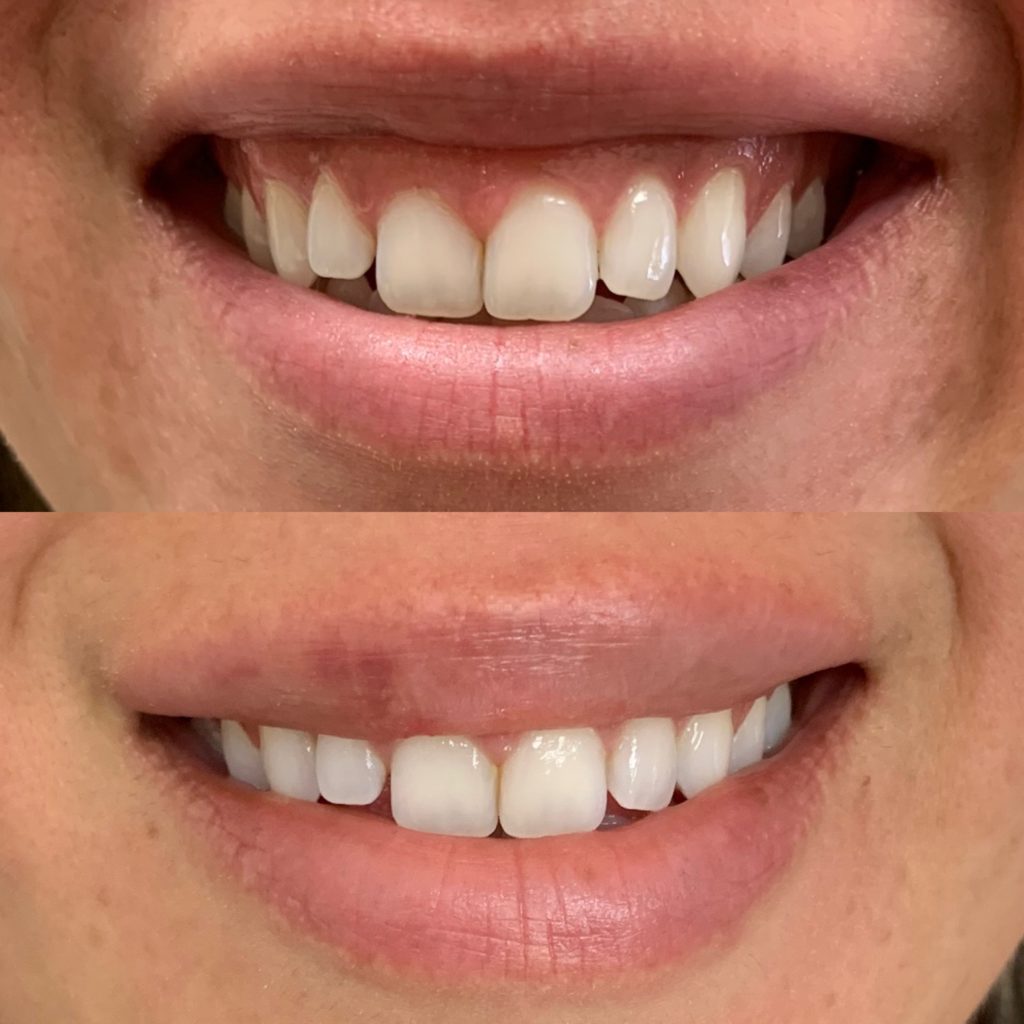 Before and After Botox Gummy Treatment | Beauty Boost Med Spa in Newport Beach, CA