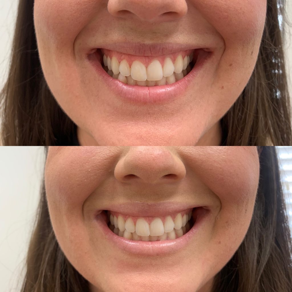 Before and After Botox Gummy Treatment | Beauty Boost Med Spa in Newport Beach, CA