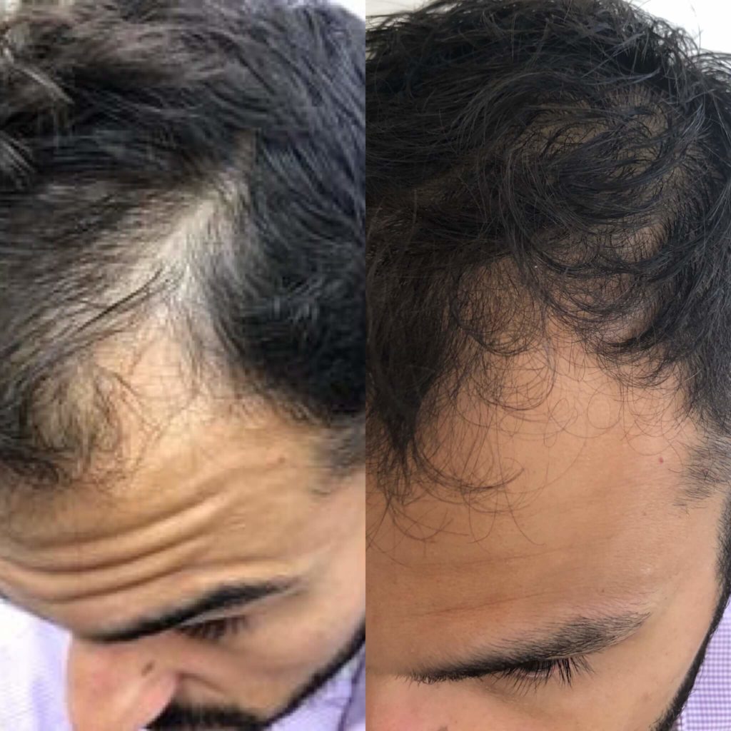 Before and After Hair Restoration Treatment | Beauty Boost Med Spa in Newport Beach, CA