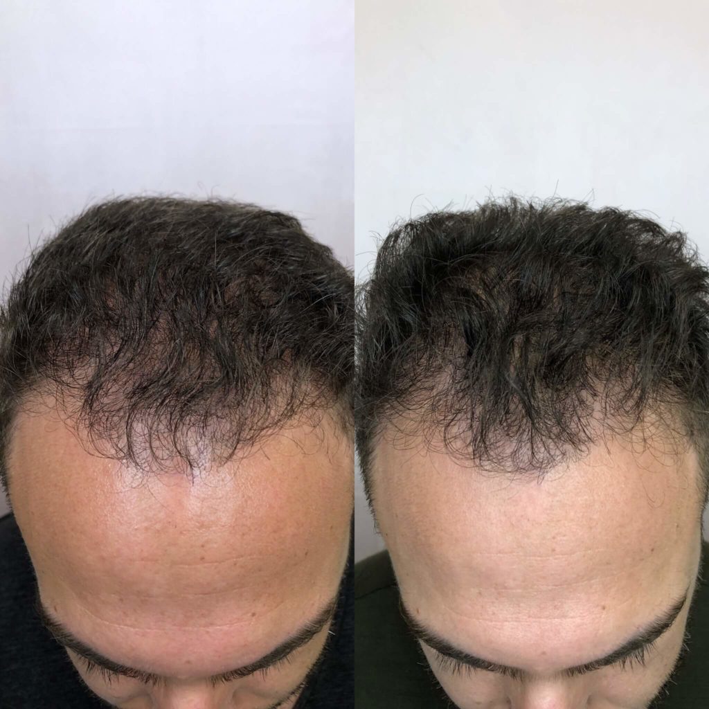 Before and After Hair Restoration Treatment | Beauty Boost Med Spa in Newport Beach, CA