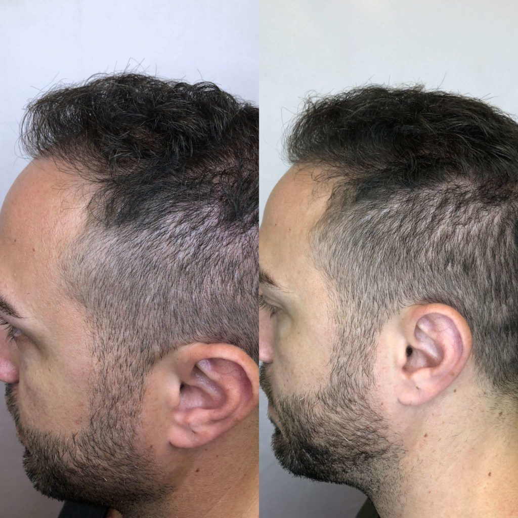 Before and After Hair Restoration Treatment | Beauty Boost Med Spa in Newport Beach, CA