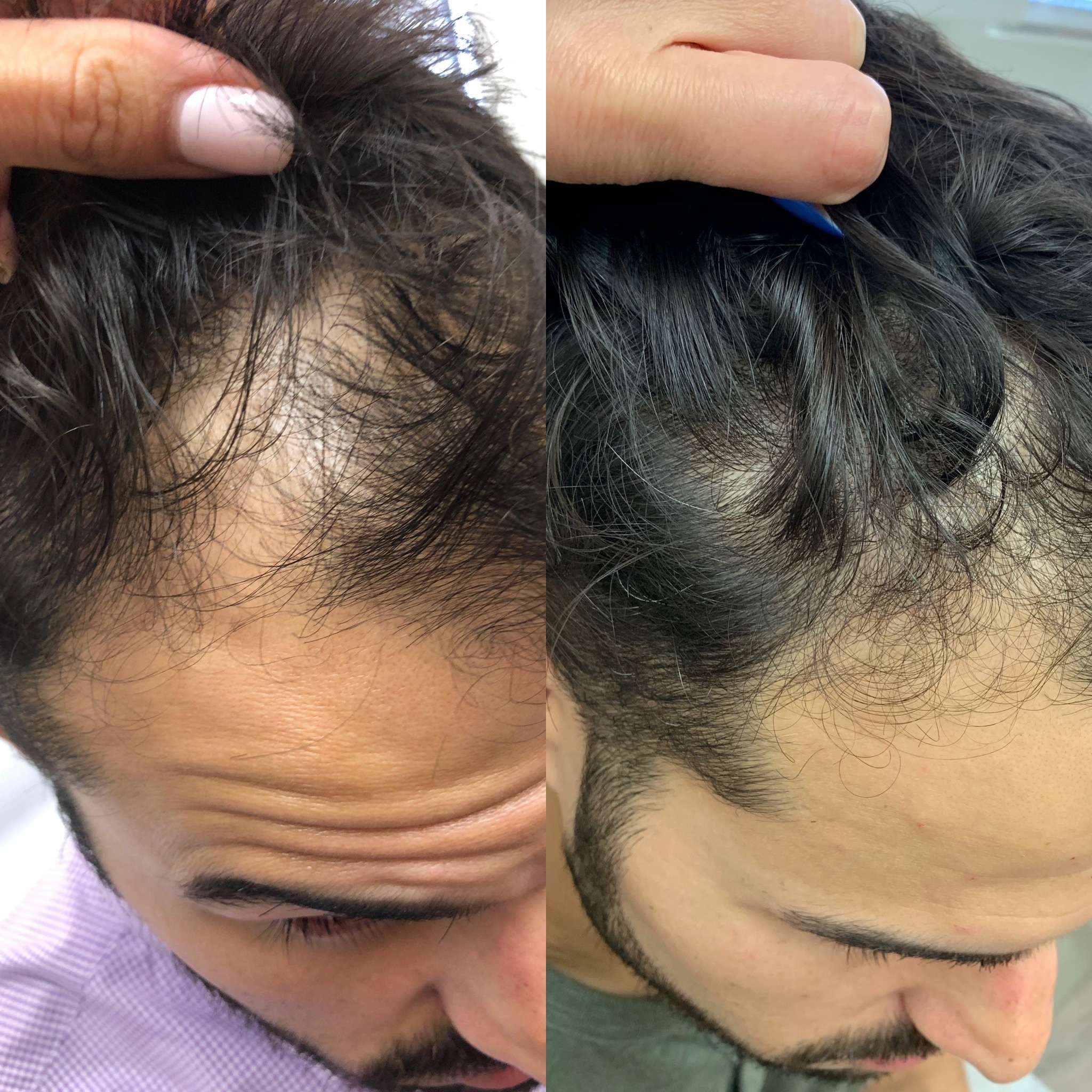 Before and After Hair Restoration Treatment | Beauty Boost Med Spa in Newport Beach, CA