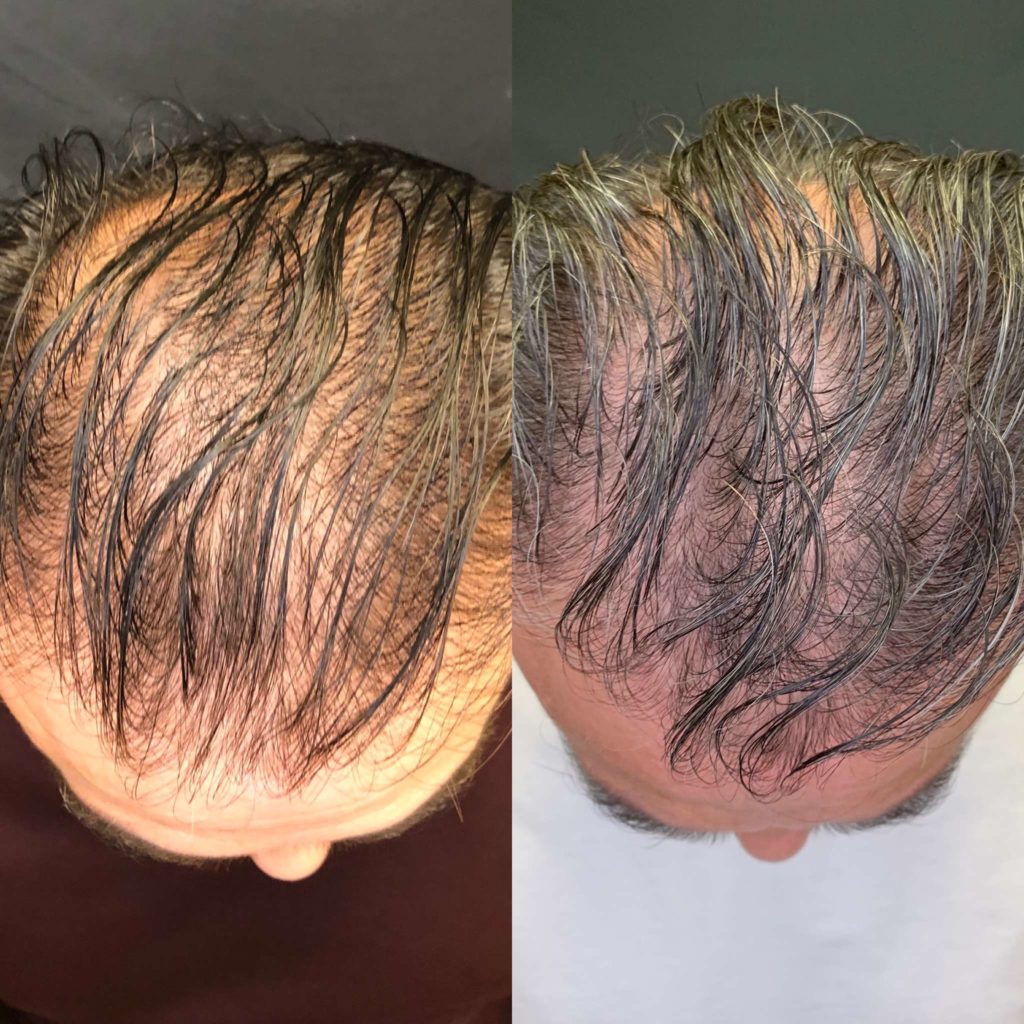Before and After Hair Restoration Treatment | Beauty Boost Med Spa in Newport Beach, CA