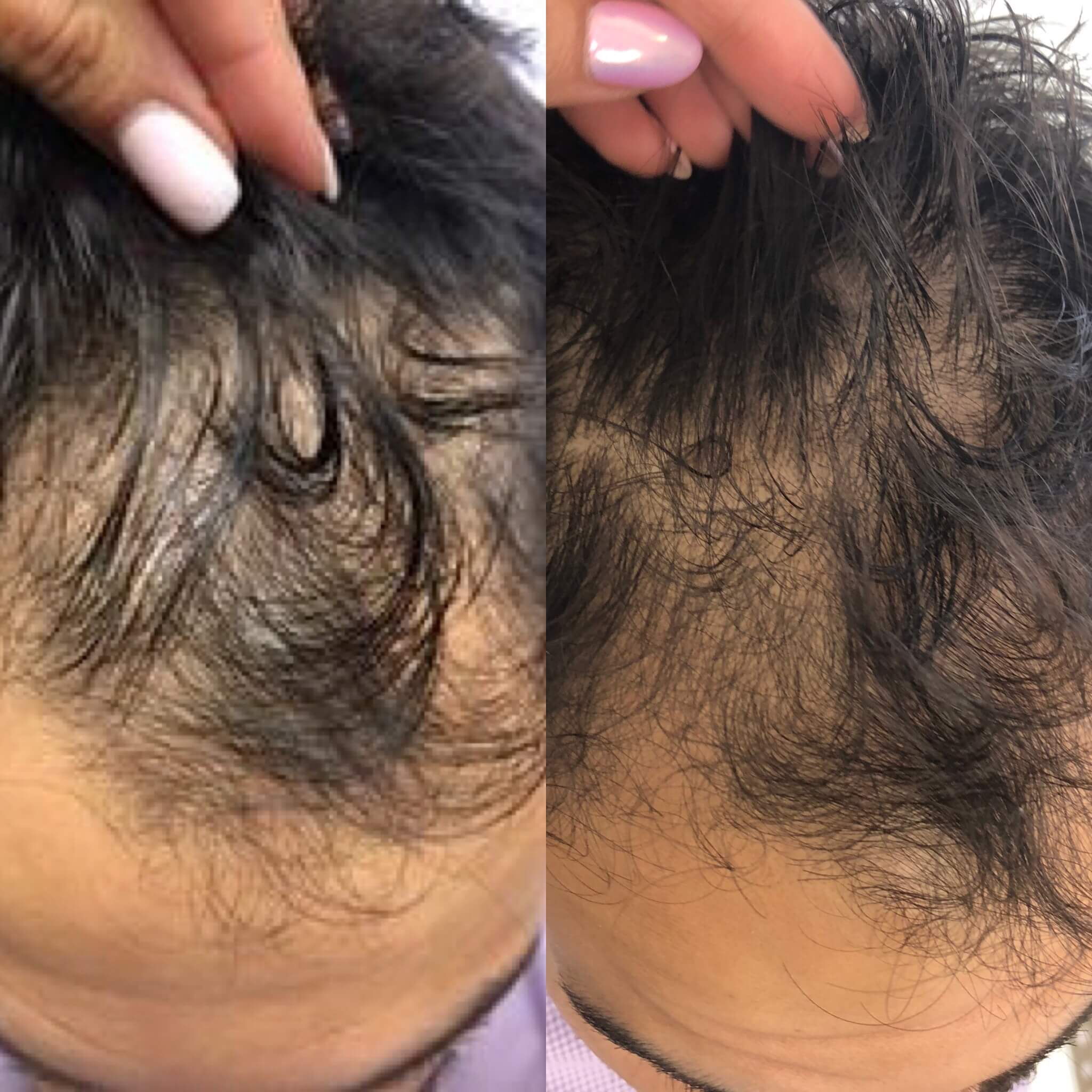 Before and After Hair Restoration Treatment | Beauty Boost Med Spa in Newport Beach, CA