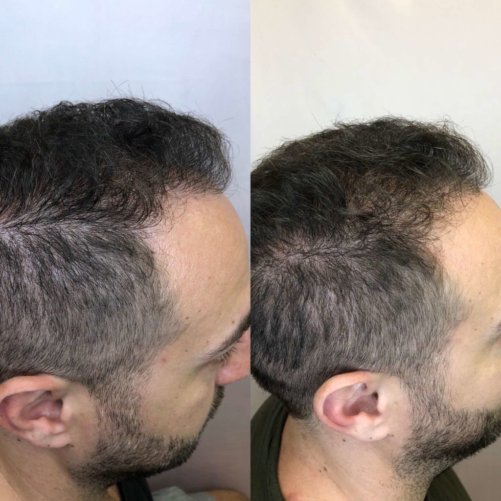 Before and After Hair Restoration Treatment | Beauty Boost Med Spa in Newport Beach, CA