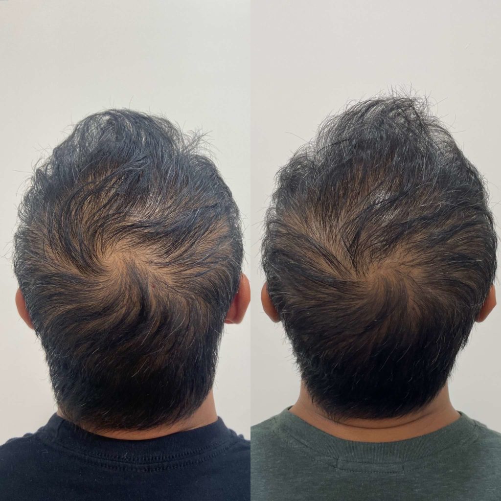 Before and After Hair Restoration Treatment | Beauty Boost Med Spa in Newport Beach, CA