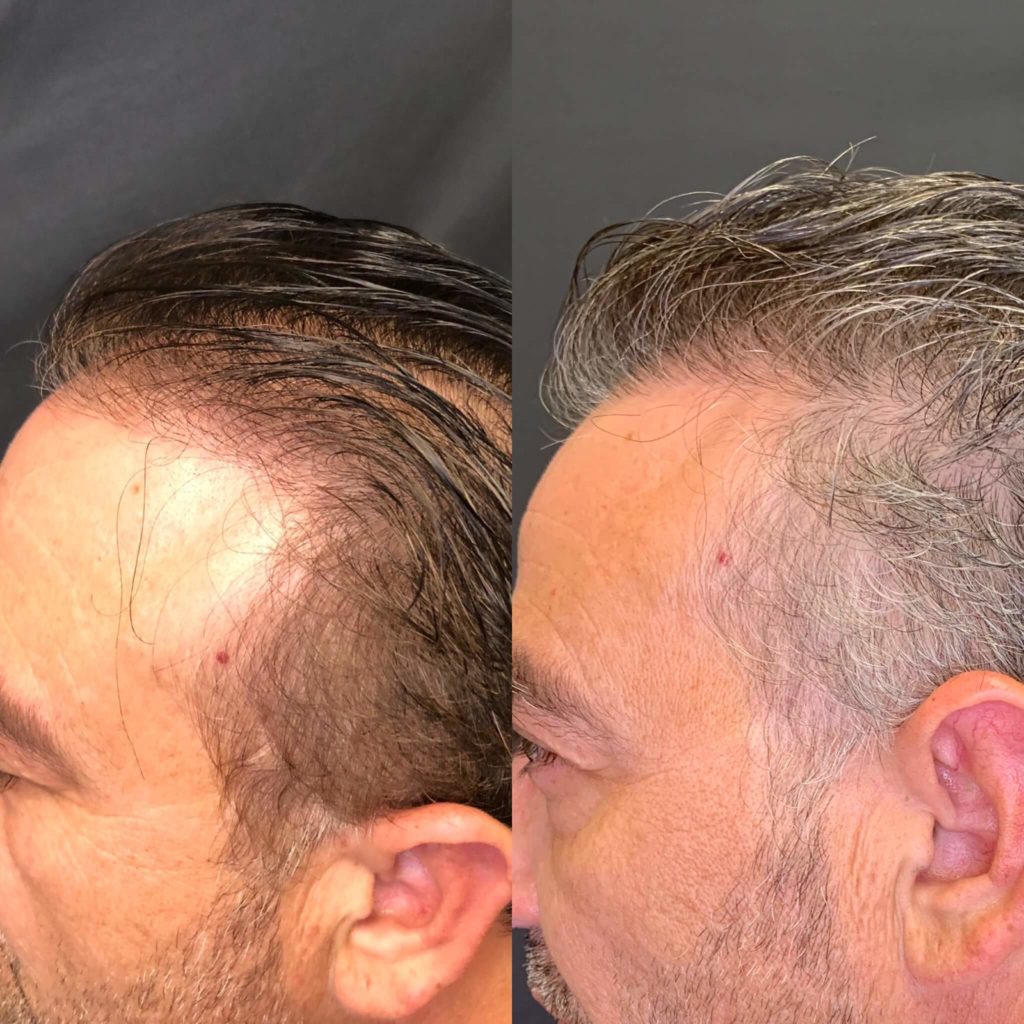Before and After Hair Restoration Treatment | Beauty Boost Med Spa in Newport Beach, CA