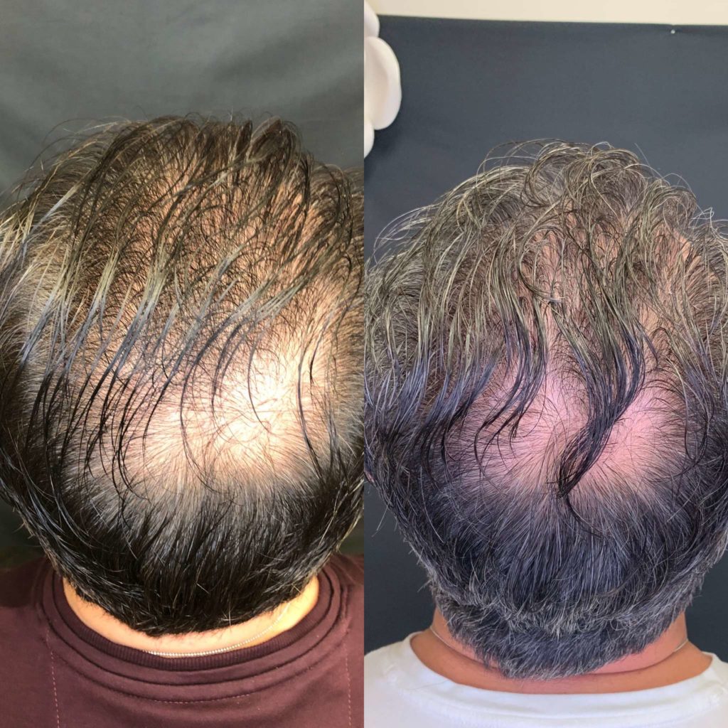 Before and After Hair Restoration Treatment | Beauty Boost Med Spa in Newport Beach, CA