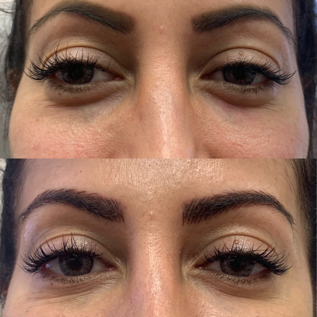 Before and After Botox Jelly Roll Treatment | Beauty Boost Med Spa in Newport Beach, CA