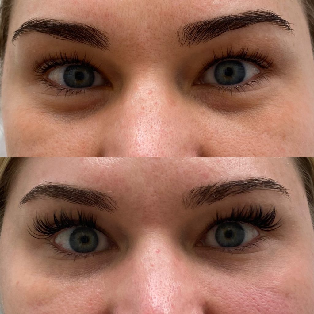 Before and After Botox Jelly Roll Treatment | Beauty Boost Med Spa in Newport Beach, CA