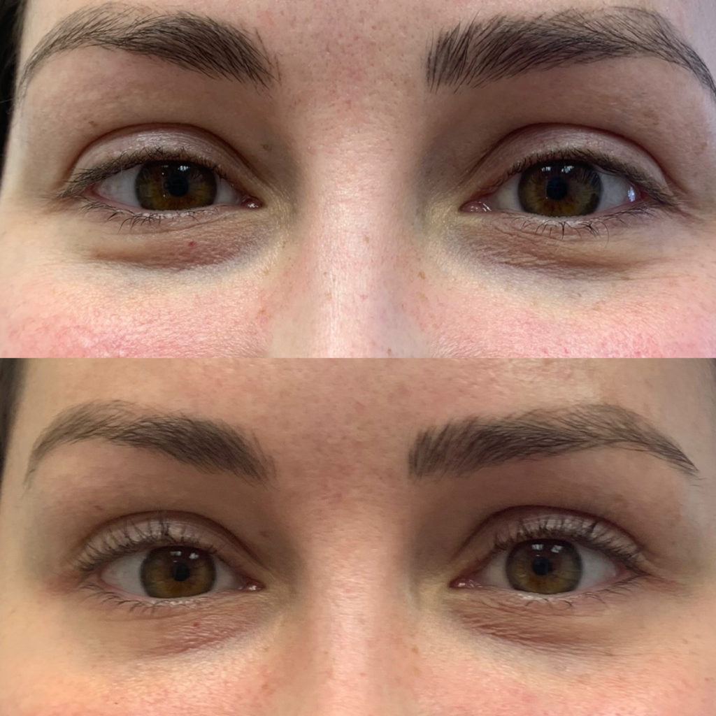 Before and After Botox Jelly Roll Treatment | Beauty Boost Med Spa in Newport Beach, CA