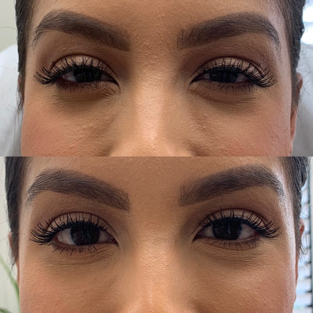 Before and After Botox Jelly Roll Treatment | Beauty Boost Med Spa in Newport Beach, CA