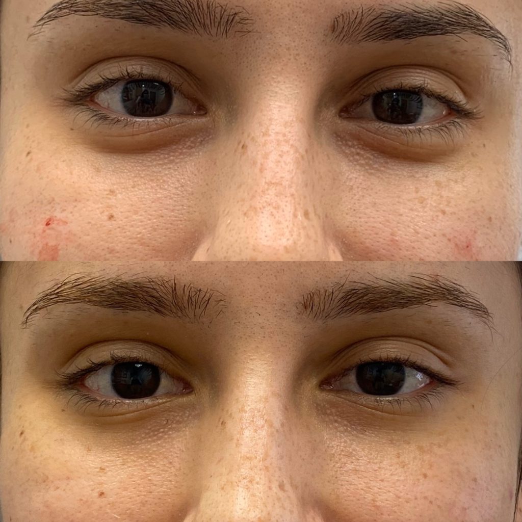 Before and After Botox Jelly Roll Treatment | Beauty Boost Med Spa in Newport Beach, CA