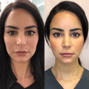 Before and After Kybella Treatment | Beauty Boost Med Spa in Newport Beach, CA