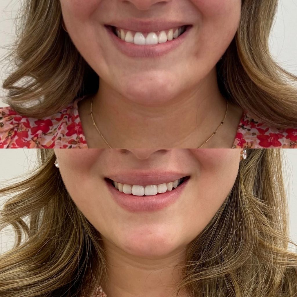 Before and After Lip lines flip Treatment | Beauty Boost Med Spa in Newport Beach, CA