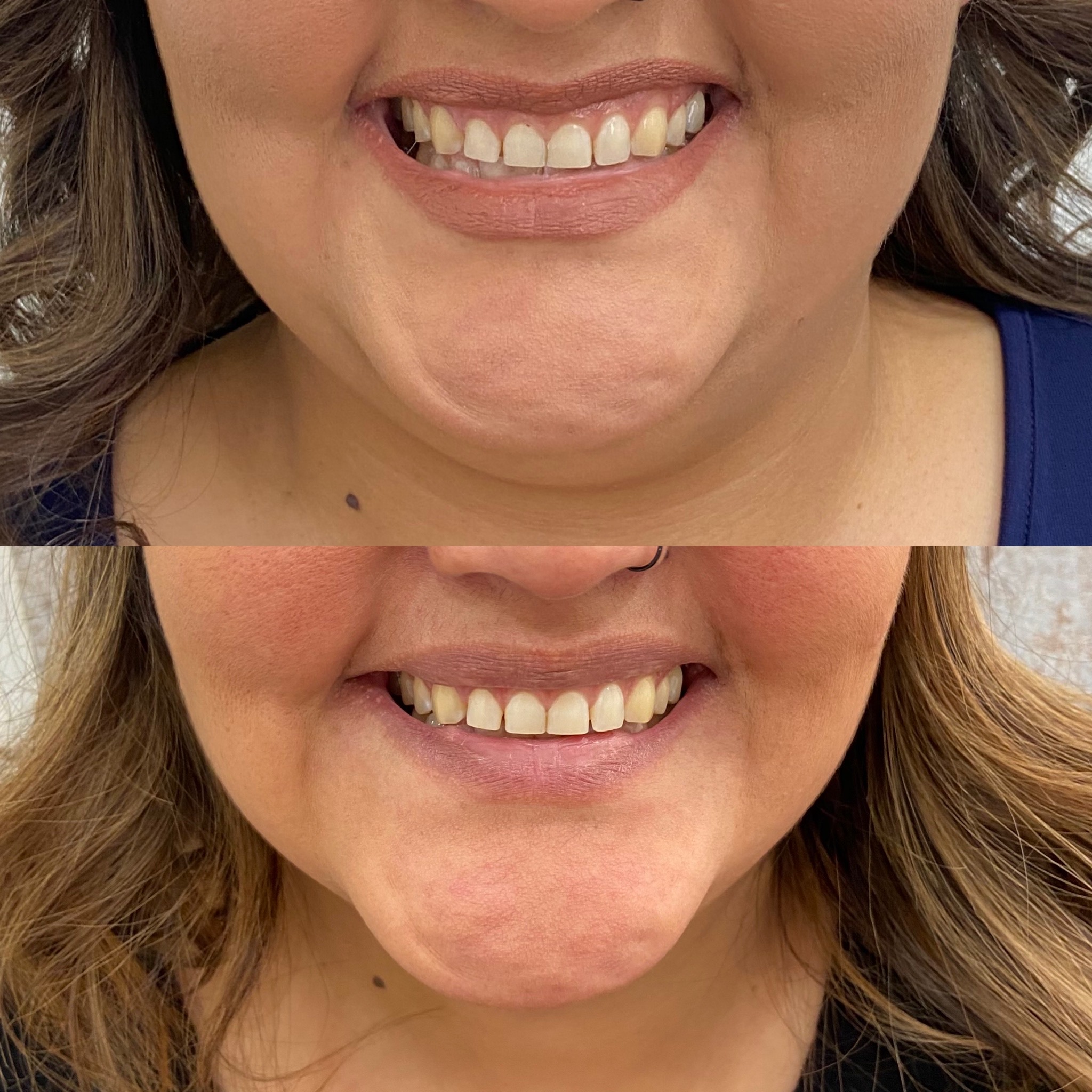 Before and After Lip lines flip Treatment | Beauty Boost Med Spa in Newport Beach, CA