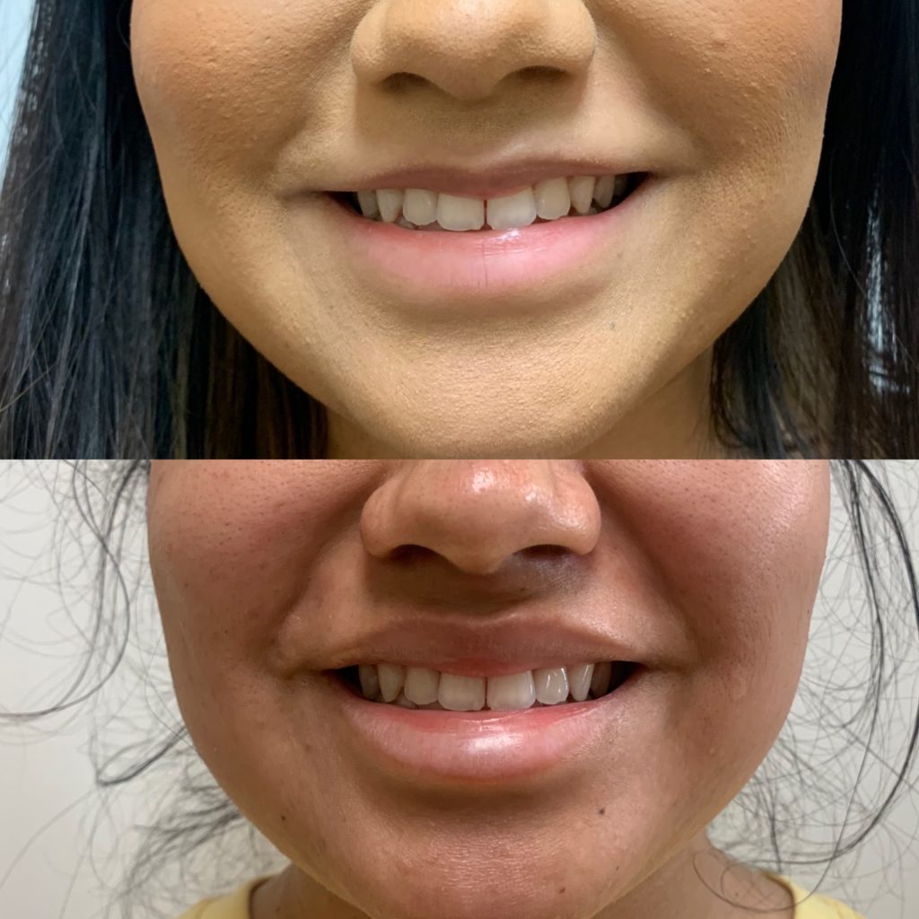 Before and After Lip lines flip Treatment | Beauty Boost Med Spa in Newport Beach, CA