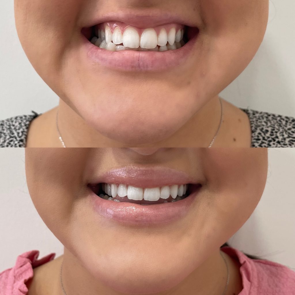 Before and After Lip lines flip Treatment | Beauty Boost Med Spa in Newport Beach, CA