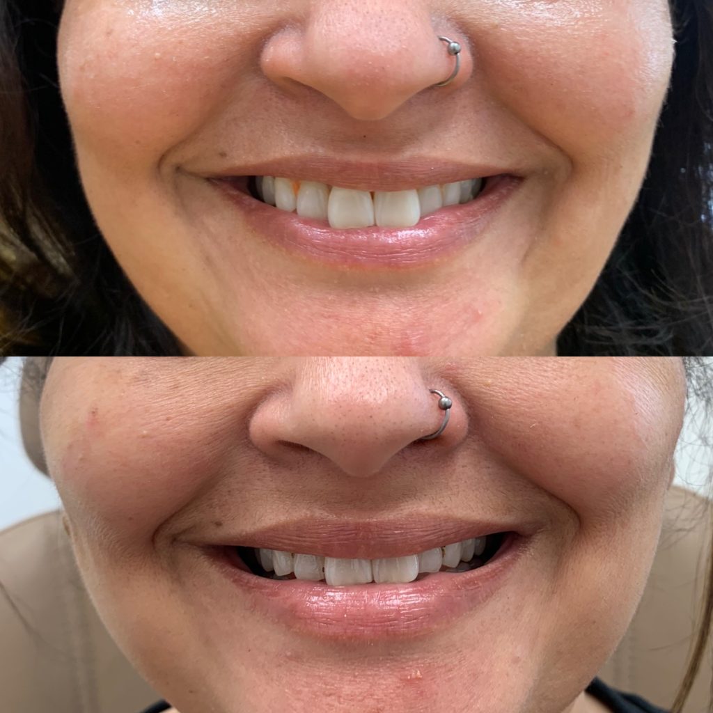 Before and After Lip lines flip Treatment | Beauty Boost Med Spa in Newport Beach, CA